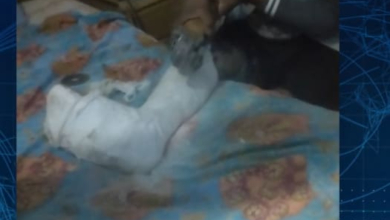 Paciente usa rebarbadeira para remover gesso após hospital provincial da Matola alegar falta de equipamento adequado