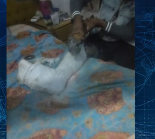 Paciente usa rebarbadeira para remover gesso após hospital provincial da Matola alegar falta de equipamento adequado